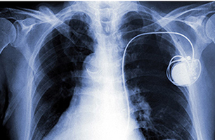 Implantable Pacmakers & Defibrillators